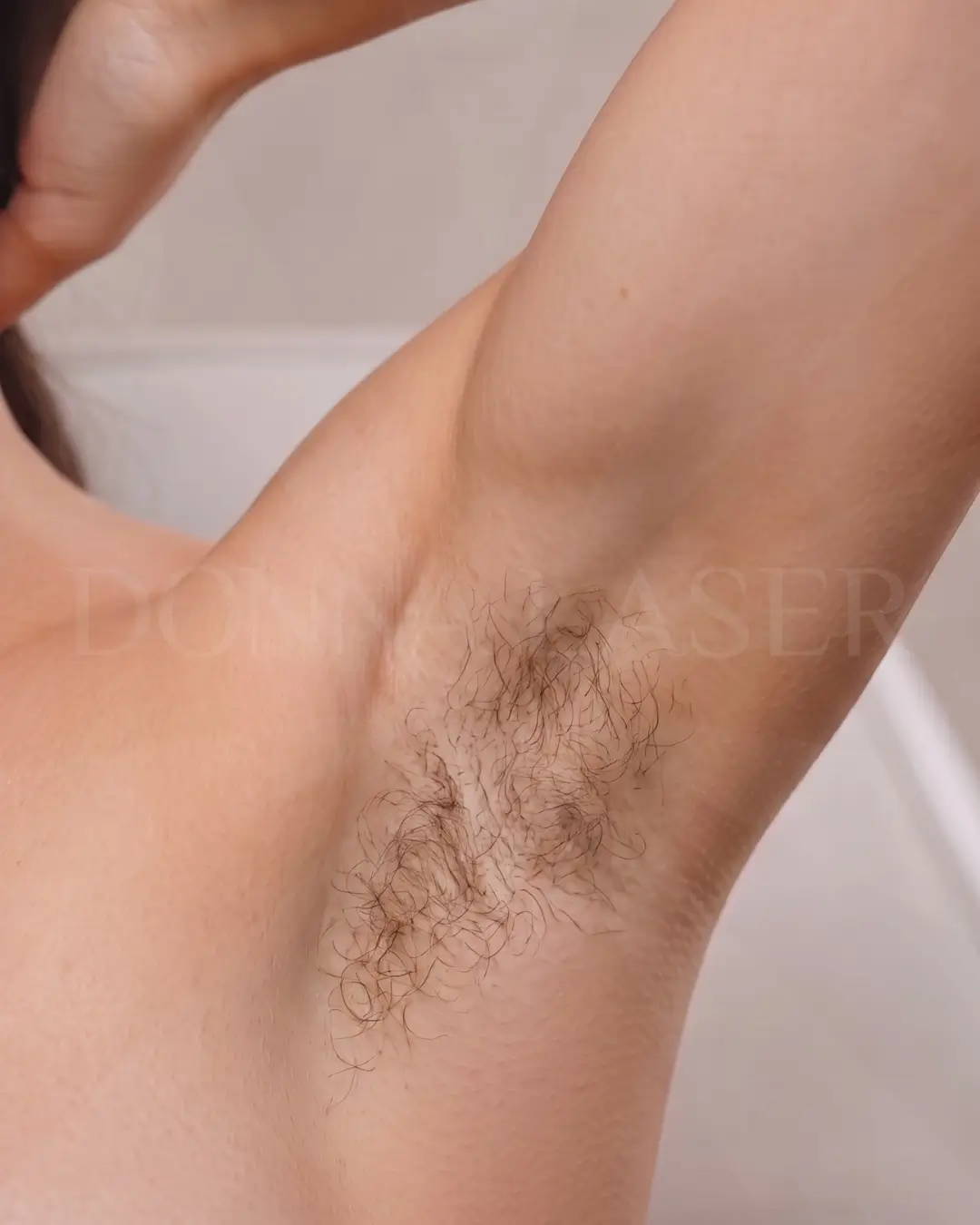 Antes — axilas com pelos, cliente Donna Laser