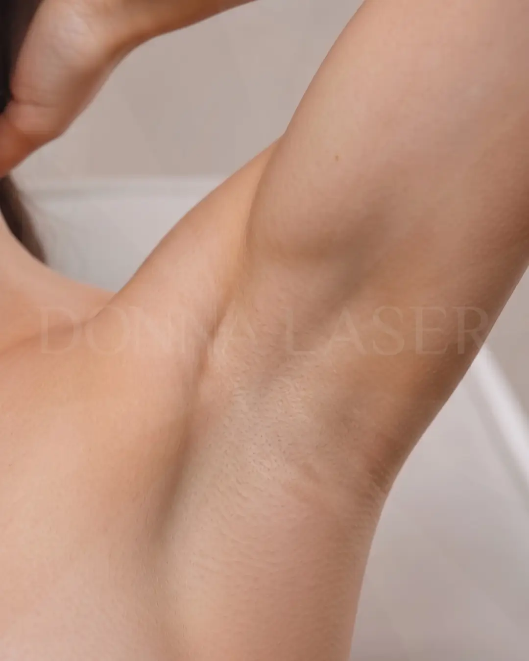 Depois — axilas lisas após depilação a laser na Donna Laser
